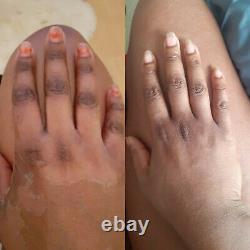 Crème correctrice éclaircissante d'hyperpigmentation pour mains, pieds